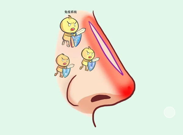 盧元?jiǎng)偙亲颖芾鬃钚孪ⅲㄖ{言證實(shí)），盧元?jiǎng)傖t(yī)生隆鼻技術(shù)好，術(shù)后9個(gè)月鼻部穩(wěn)定性高