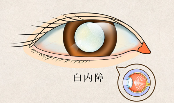 滨州人必看！2025滨州白内障手术免费条件出炉：年满60岁+农村户口即可享受惠民政策