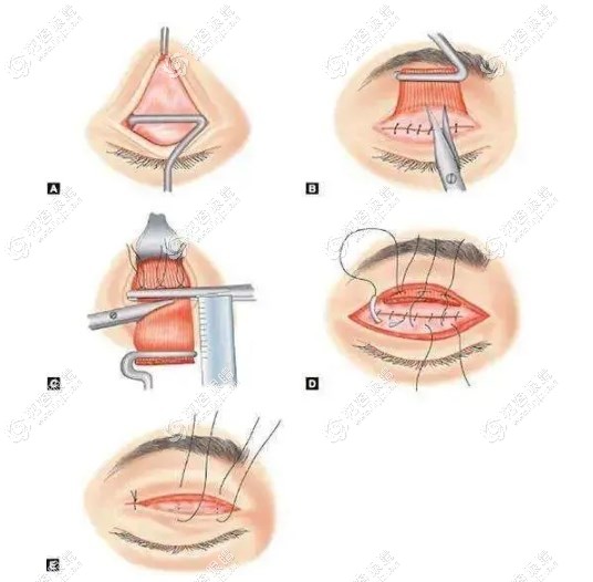 上瞼下垂手術恢復過程