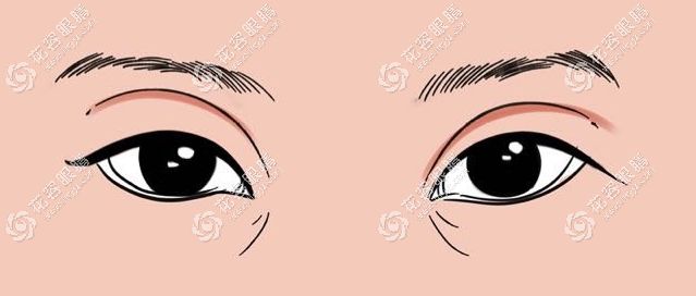 雙眼皮失敗的八種圖片：雙眼皮寬窄不一樣