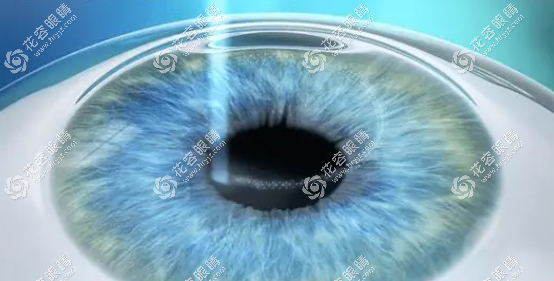 轻度干眼症能否做近视眼手术要根据具体情况来定