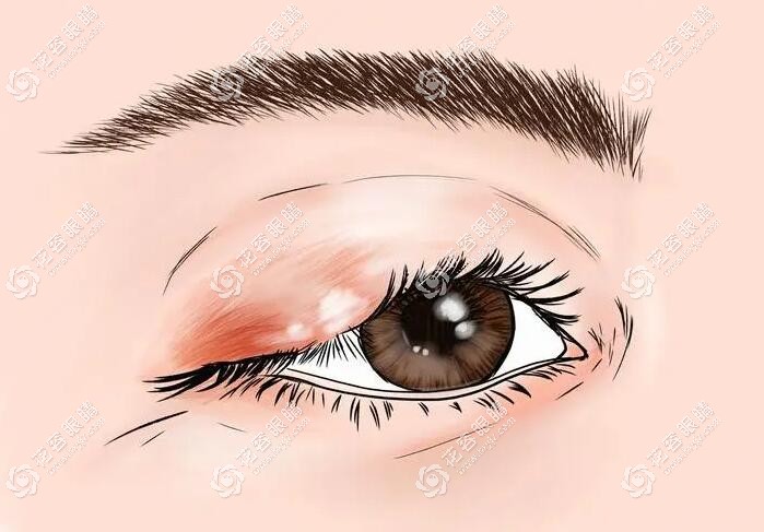 眼睛里长麦粒肿怎么治疗好得快?消除麦粒肿的办法送给大家