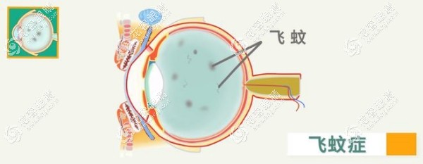 眼外伤引起的飞蚊症多久能恢复?外伤飞蚊症一般一个月能好