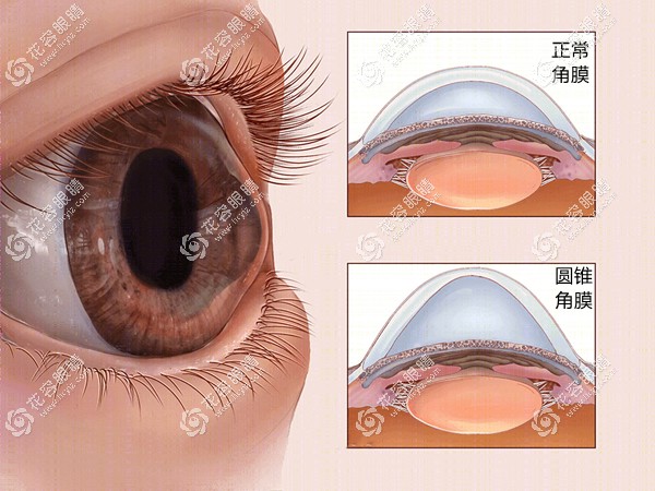 圆锥角膜能做近视眼手术吗?能做晶体植入但不能做飞秒激光