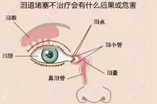 泪道阻塞不治疗会有什么后果/危害?泪道堵塞对眼睛的影响有
