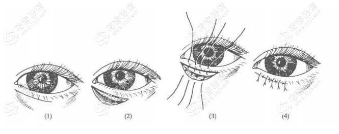 下眼瞼內翻手術會留疤嗎?一般不會有明顯疤痕沒啥不良后果