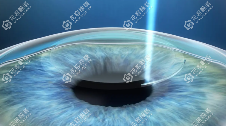 近視眼手術(shù)醫(yī)生免費咨詢,問診預(yù)約掛號全/半飛秒/晶體植入