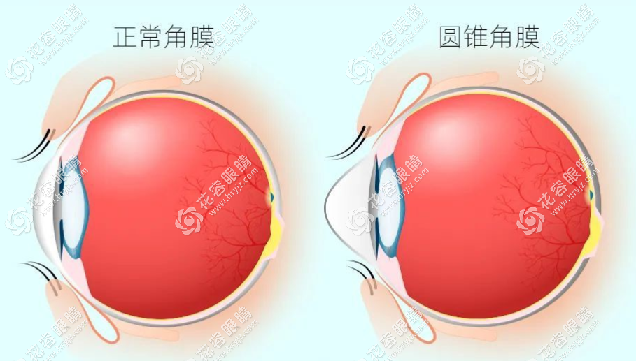 圆锥角膜手术费用2万+治疗圆锥角膜好的眼科医院是爱尔眼科