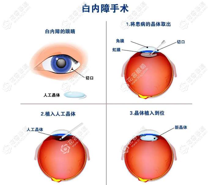 白內障手術兩只眼睛晶體不一樣有什么后果?3大后果要知道！