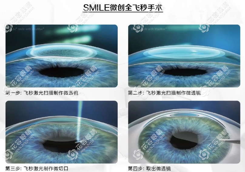 南京全飞秒激光手术好的医院排名前十:东南/明康/博德眼科