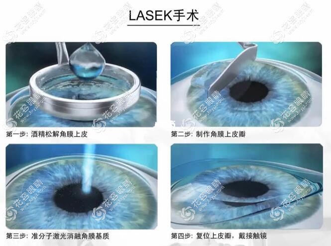 ek近視眼手術其實是LASEK手術