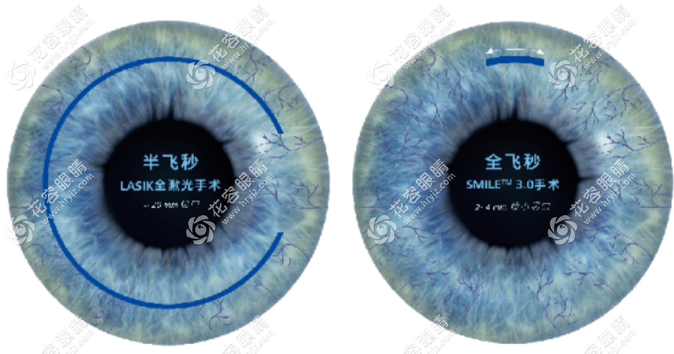 王曉瑛醫(yī)生預(yù)約掛號(hào)+出診時(shí)間地址揭曉,做全飛秒手術(shù)1.8萬(wàn)起