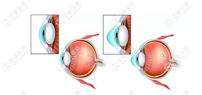 圆锥角膜治疗视力较快的办法,其中角膜交联术控制10年左右