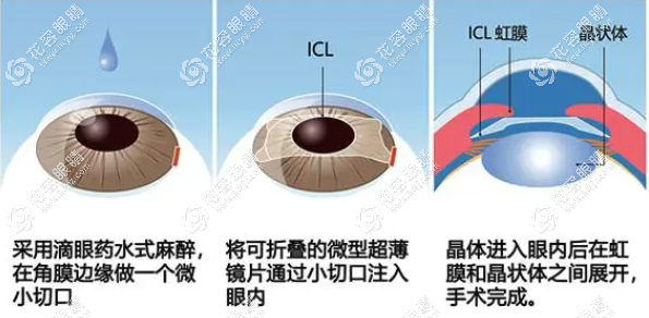 北京做青光眼引發的白內障晶體植入好的醫院有哪些?何氏等