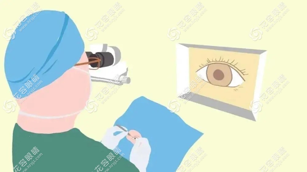 做了斜視手術可以做近視手術，但需1-3月恢復時間