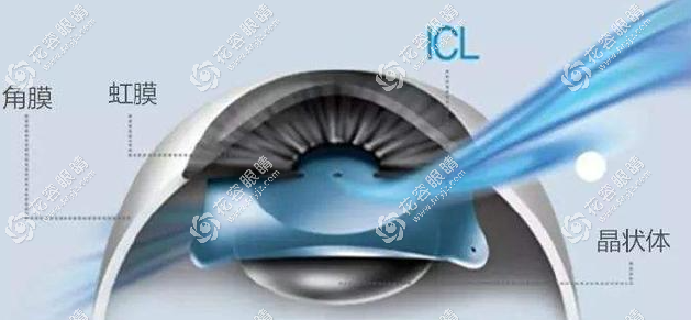 鄭州晶體植入近視眼手術價格，ICL不帶散光26800+/帶散光30000+