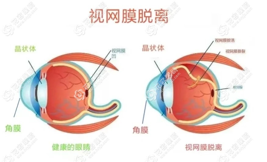 視網膜脫離手術
