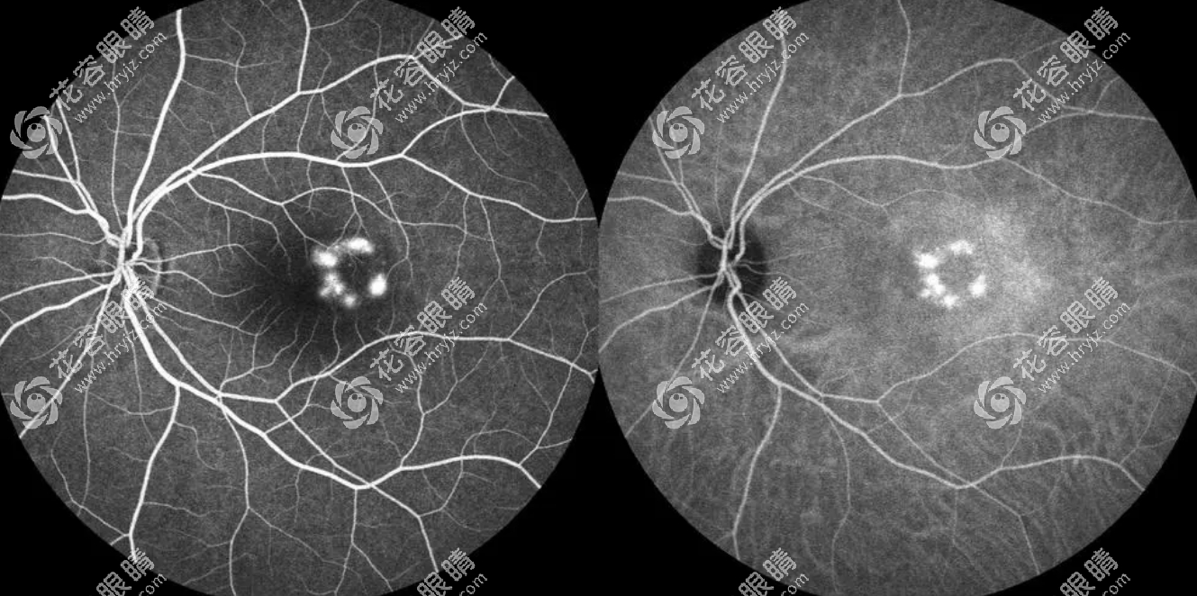 中浆眼病，又称为中心性浆液性视网膜脉络膜病变
