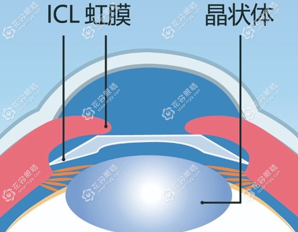 ICL晶体植入对前房深度的要求