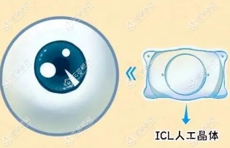 深圳爱尔眼科晶体植入手术做的好价格2.98w+/高度近视可预约
