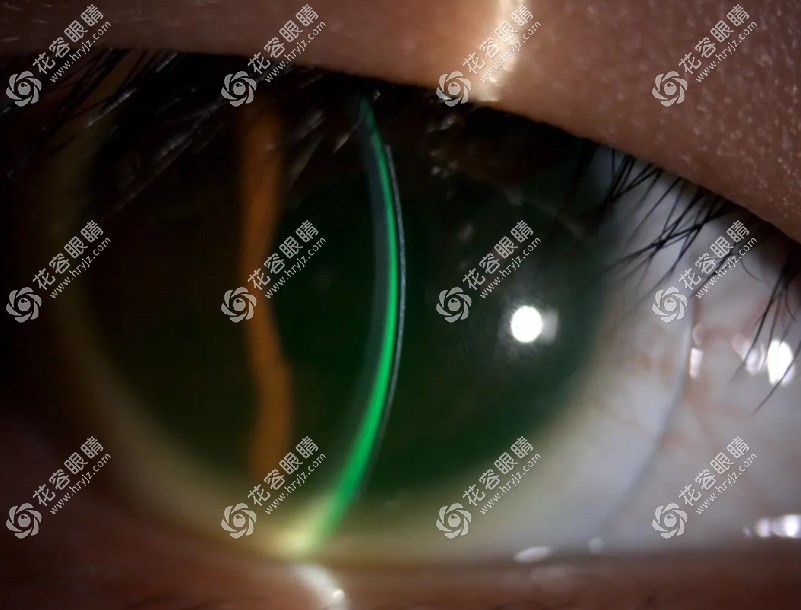 北京爱尔新力眼科为圆锥角膜顾客配巩膜镜,视力恢复超预期