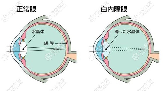 糖尿病得了白內(nèi)障能治好嗎
