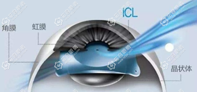 ICL晶体植入手术~花容眼睛