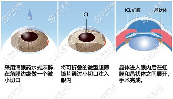 ICL晶体术后的眼部检查 