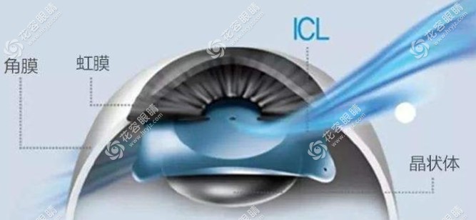 合肥可以做icl晶體植入,比較好的公辦/私立醫(yī)院有10家
