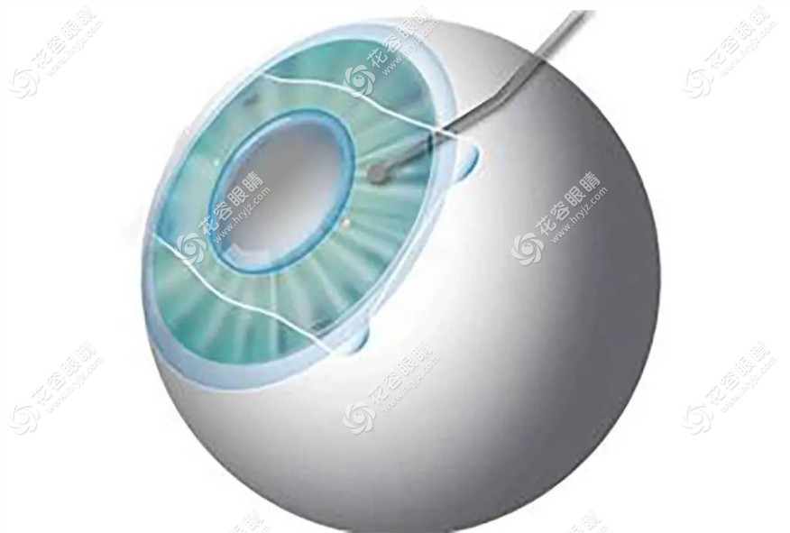 广州眼科医院ICL晶体植入价格汇总,近视族必看