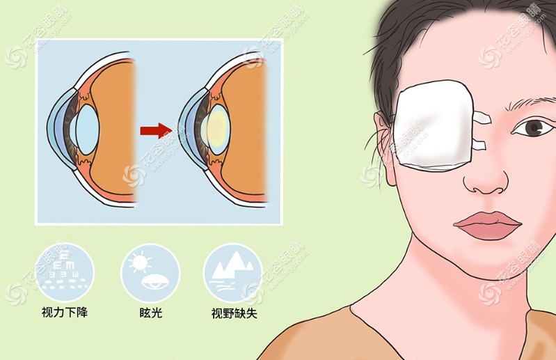 爱尔眼科角膜移植成功几率高