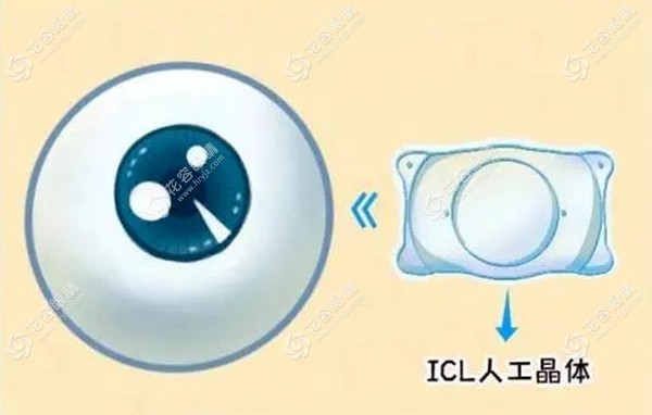上海和平眼科ICL晶体植入近视手术优势