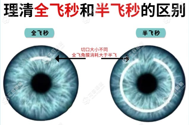 全飛秒手術(shù)