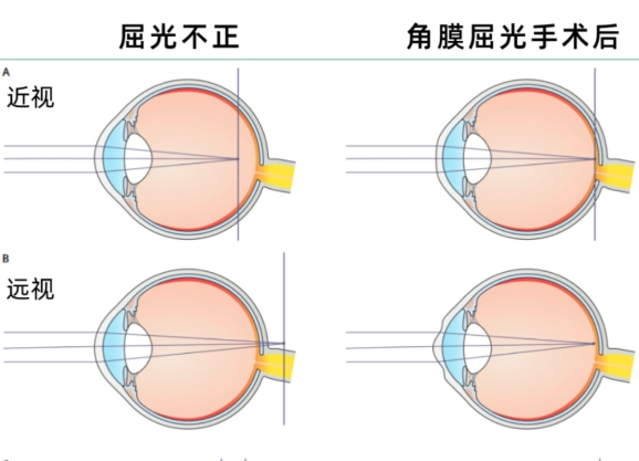 爱尔眼科近视手术