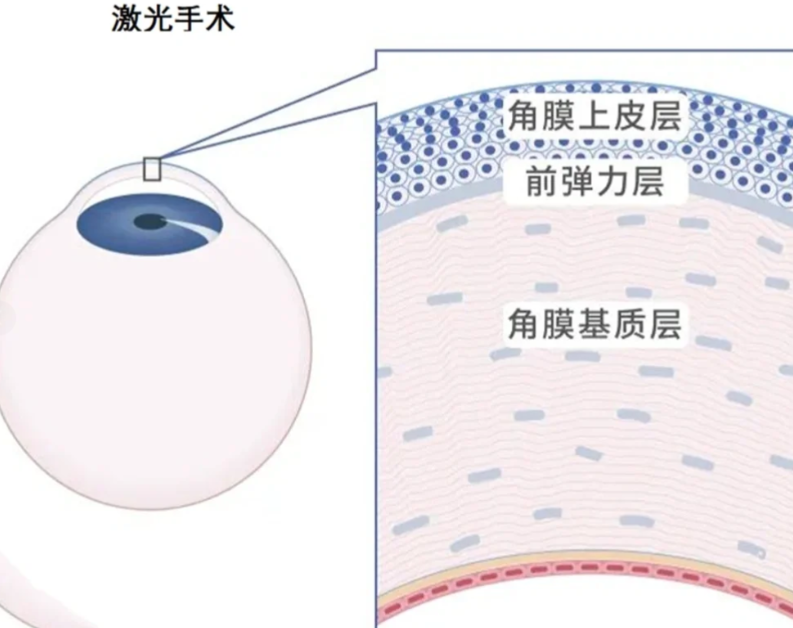 南宁近视矫正