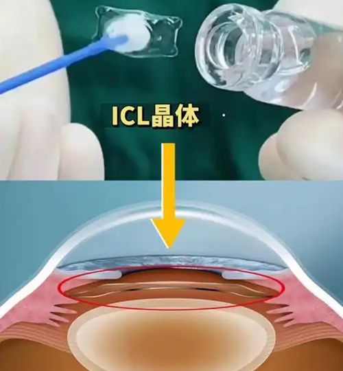 2025昆明胡敏眼科医生价格收费表公开，ICL晶体植入3万起，附高度近视手术费用详细说明