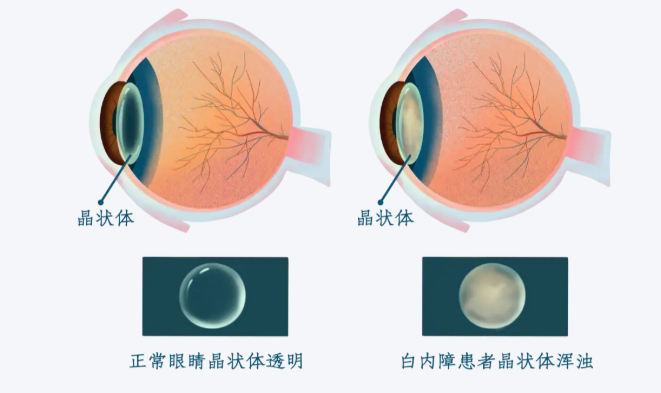 2025昆明白內(nèi)障手術(shù)價(jià)格表，超聲乳化、飛秒激光輔助白內(nèi)障手術(shù)收費(fèi)全都有