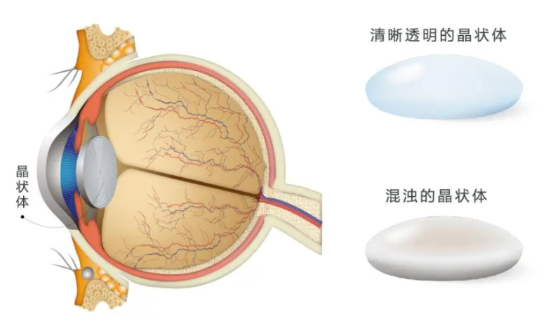 昆明白内障手术实例故事