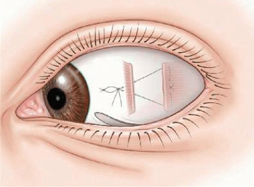 上海李寧東醫(yī)生治療垂直性斜視怎么樣？患者口碑良好