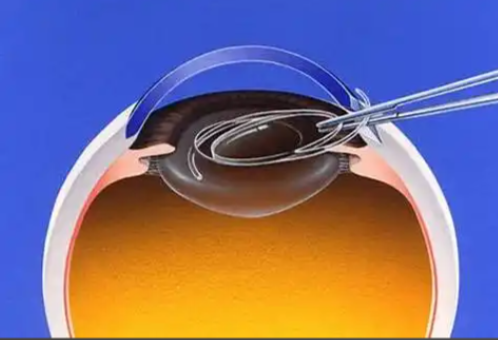 呂梁康明眼科白內(nèi)障手術(shù)實(shí)例故事