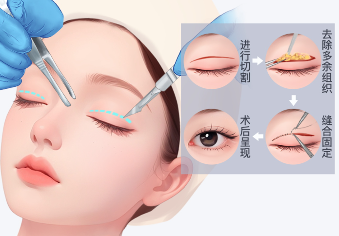 成都公辦醫(yī)院近視手術(shù)推薦參考