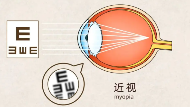 重慶胡春明醫(yī)生做近視手術(shù)好嗎？從患者角度看近視手術(shù)