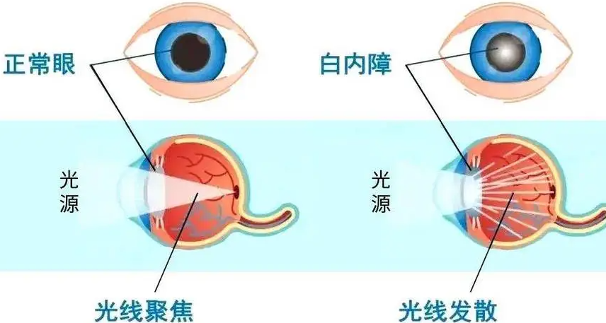白內(nèi)障微創(chuàng)手術突破  