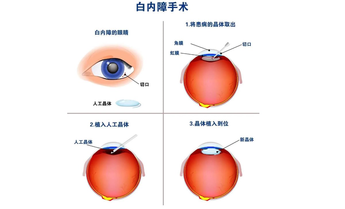 眼部人工晶體置換手術