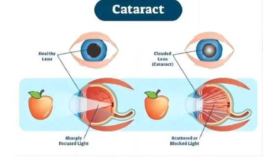 眼部人工晶體置換手術