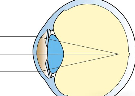 珠海近視手術(shù)價(jià)格清單