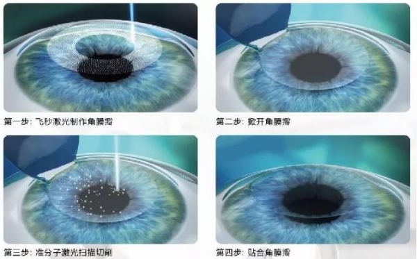 蘭州愛爾眼科醫(yī)院全飛秒和半飛秒怎么選？角膜厚選全飛秒，散光高選半飛秒，姚慧院長一對一評估！