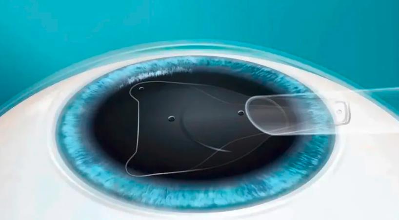 二、梅州愛明眼科近視手術(shù)找哪個醫(yī)生好？鐘院長全飛秒技術(shù)優(yōu)勢解析