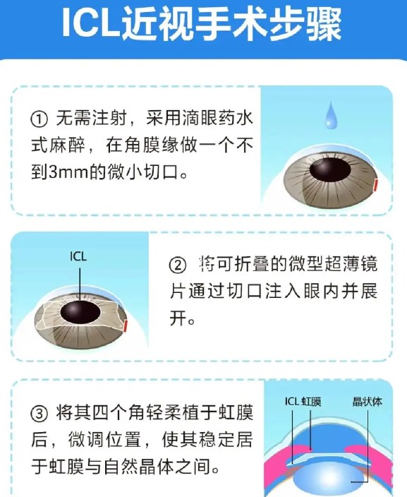 三、全飛秒/ICL個性化定制，適配不同眼部條件