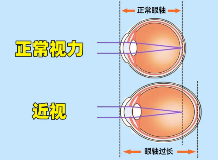 重庆叶剑和汪红做近视手术哪个好？临床手术经验对比